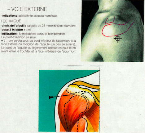 Hexatrione infiltration